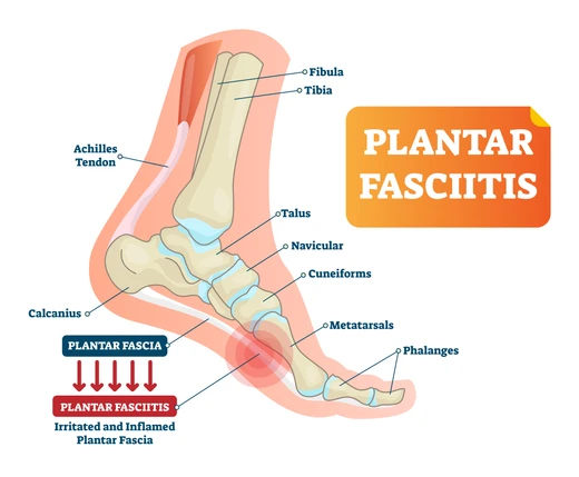 Best sandals for plantar fasciitis